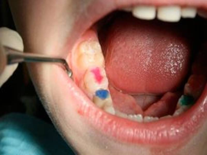 Пломба на молочный зуб: нужно ли ставить?